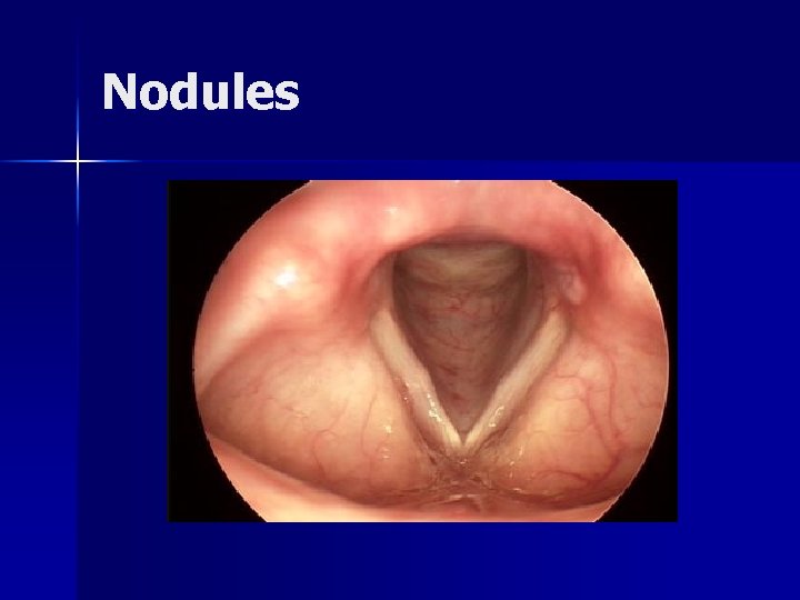 Nodules 