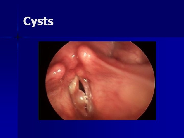 Cysts 