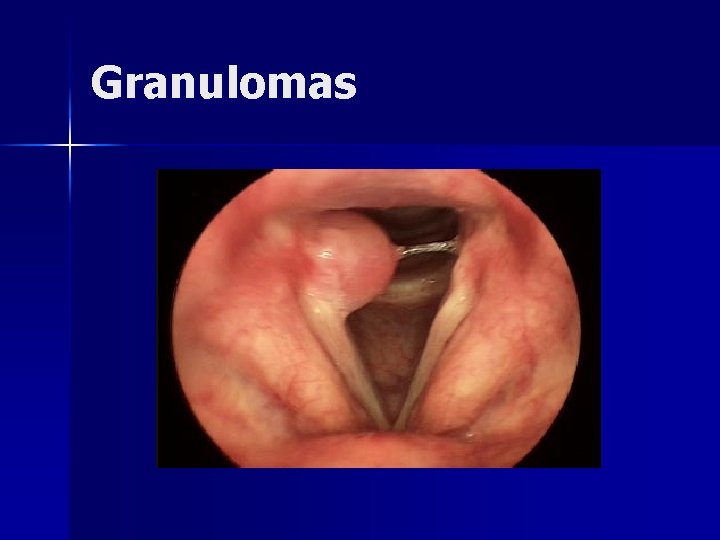 Granulomas 