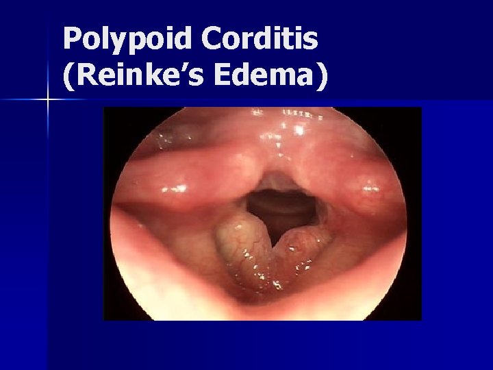Polypoid Corditis (Reinke’s Edema) 