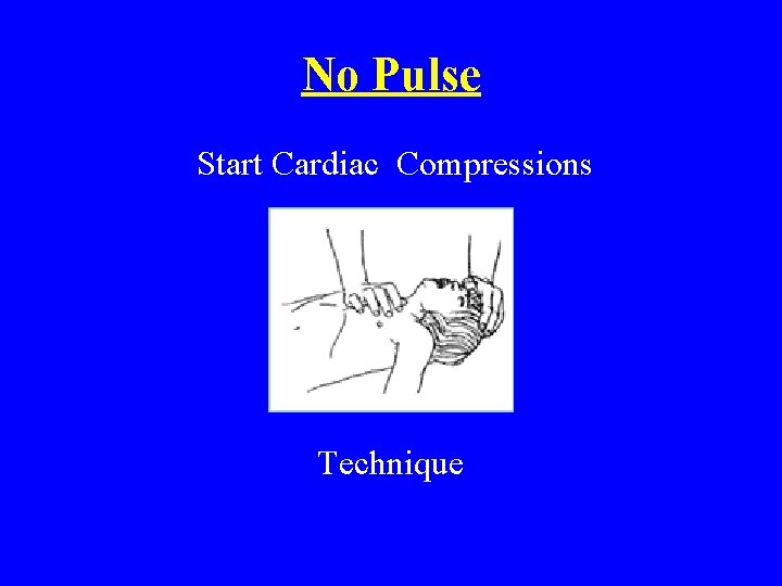 No Pulse Start Cardiac Compressions Technique 