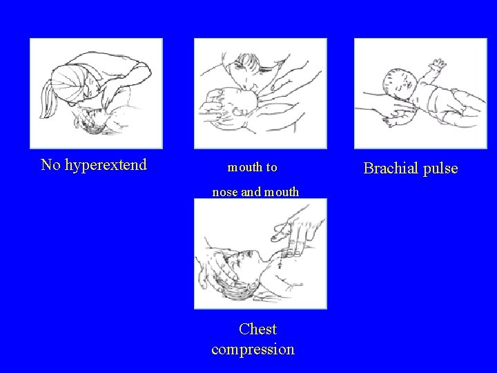 No hyperextend mouth to nose and mouth Chest compression Brachial pulse 
