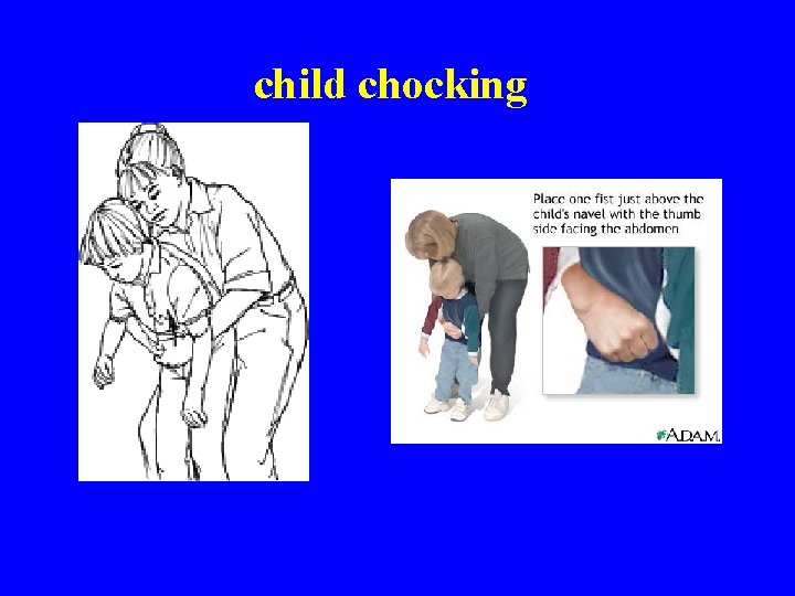 child chocking 