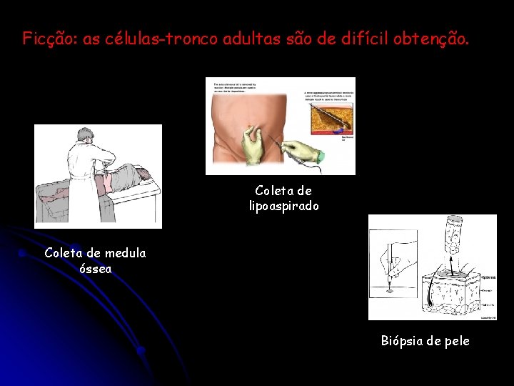 Ficção: as células-tronco adultas são de difícil obtenção. Coleta de lipoaspirado Coleta de medula