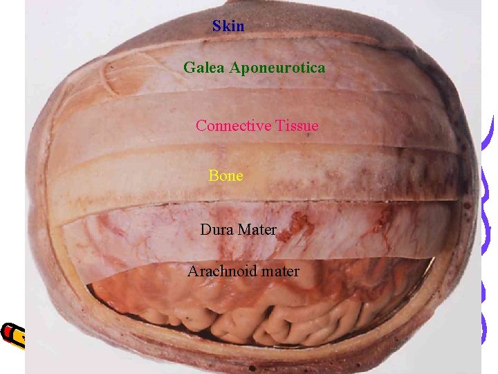 Skin Galea Aponeurotica Connective Tissue Bone Dura Mater Arachnoid mater 