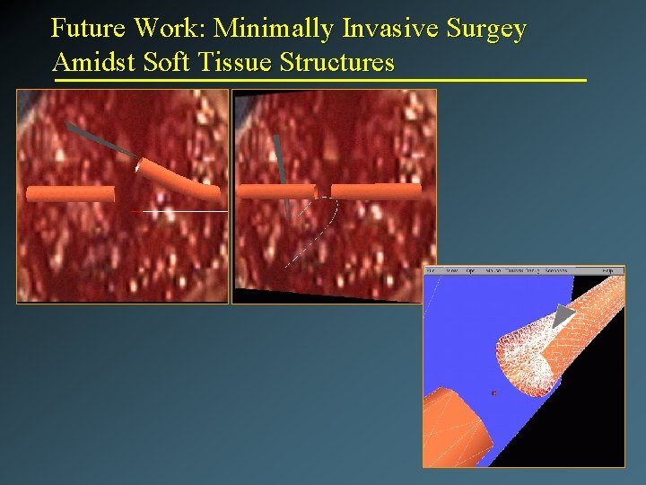 Future Work: Minimally Invasive Surgey Amidst Soft Tissue Structures 