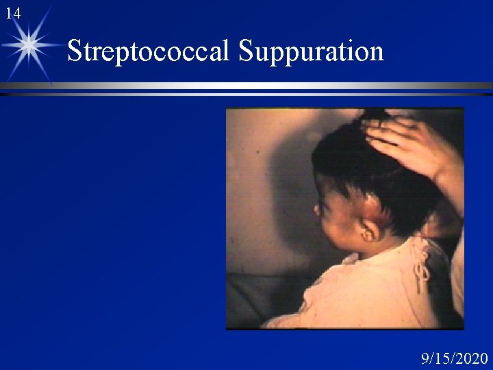 14 Streptococcal Suppuration 9/15/2020 