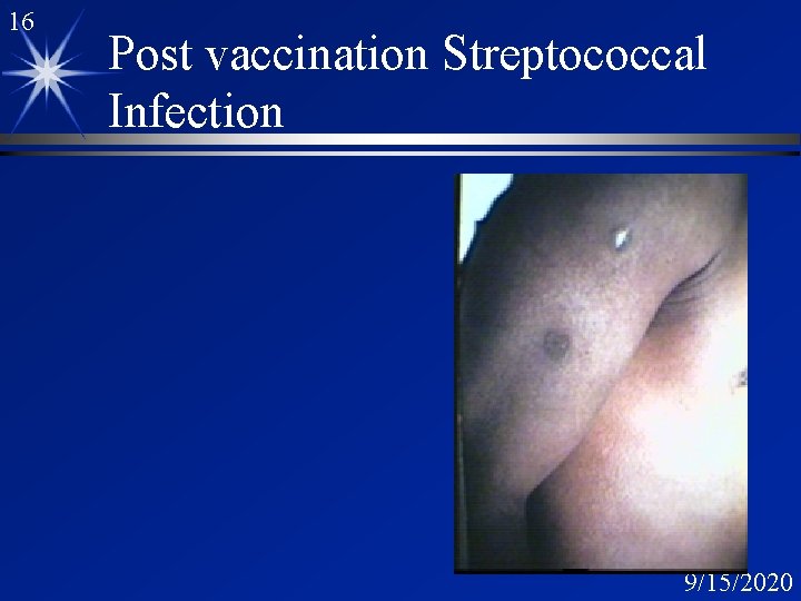 16 Post vaccination Streptococcal Infection 9/15/2020 