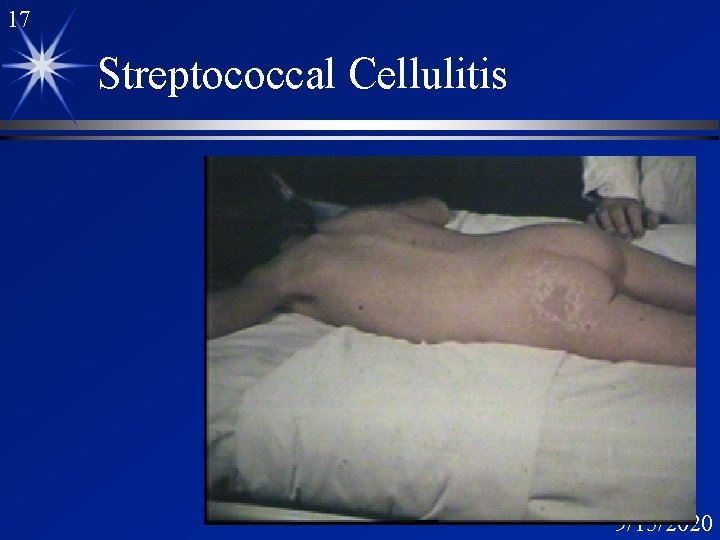 17 Streptococcal Cellulitis 9/15/2020 