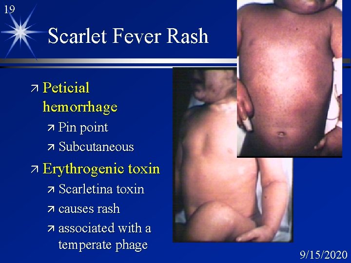 19 Scarlet Fever Rash ä Peticial hemorrhage ä Pin point ä Subcutaneous ä Erythrogenic