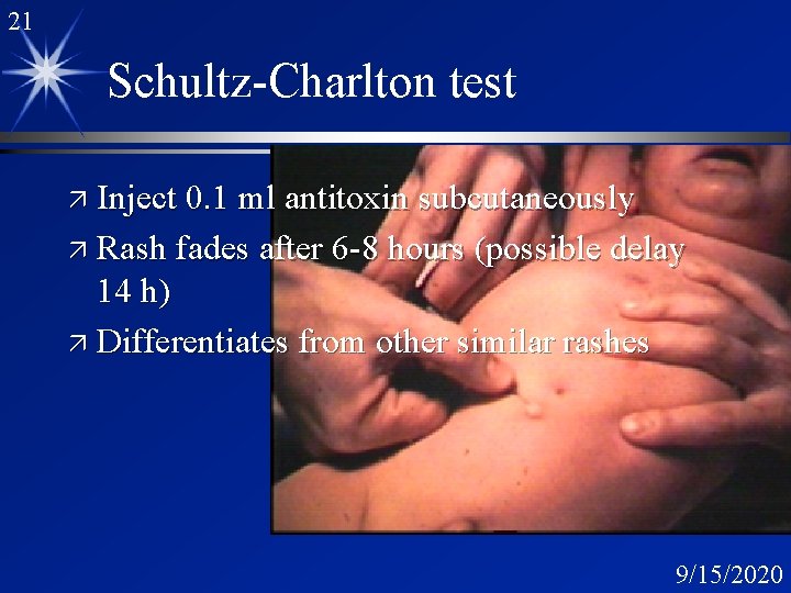 21 Schultz-Charlton test ä Inject 0. 1 ml antitoxin subcutaneously ä Rash fades after