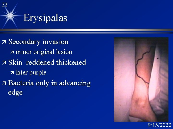 22 Erysipalas ä Secondary invasion ä minor original lesion ä Skin reddened thickened ä