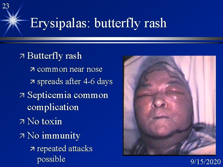 23 Erysipalas: butterfly rash ä Butterfly rash ä common near nose ä spreads after