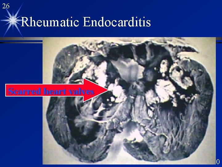 26 Rheumatic Endocarditis Scarred heart valves 9/15/2020 