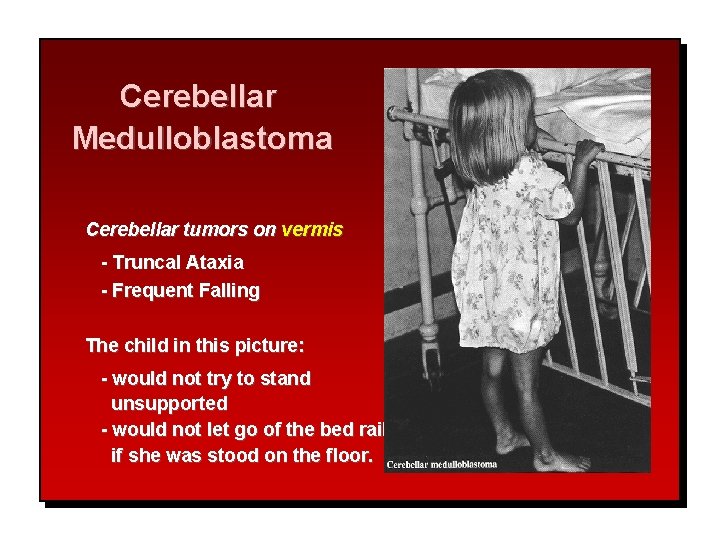 Cerebellar Medulloblastoma Cerebellar tumors on vermis - Truncal Ataxia - Frequent Falling The child