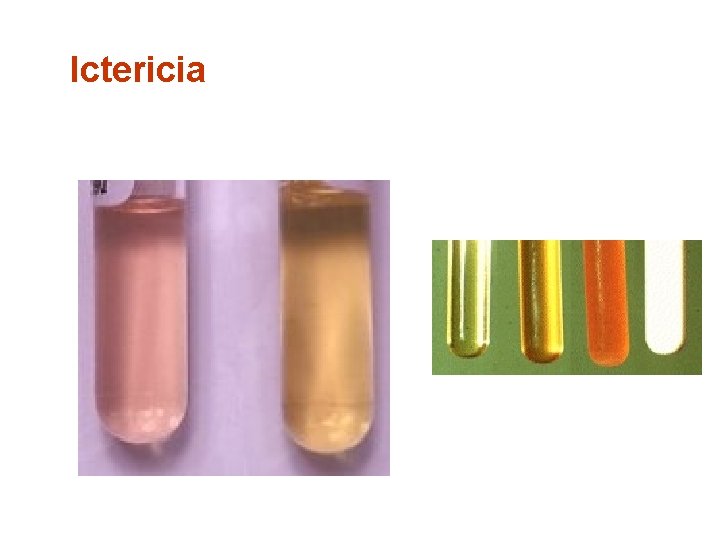 Ictericia 