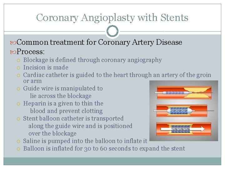 Coronary Angioplasty with Stents Common treatment for Coronary Artery Disease Process: Blockage is defined