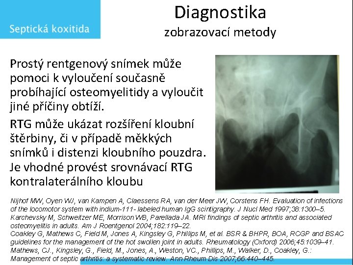 Diagnostika zobrazovací metody Prostý rentgenový snímek může pomoci k vyloučení současně probíhající osteomyelitidy a