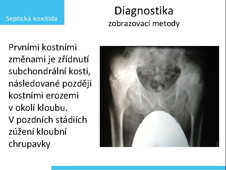 Diagnostika zobrazovací metody Prvními kostními změnami je zřídnutí subchondrální kosti, následované později kostními erozemi