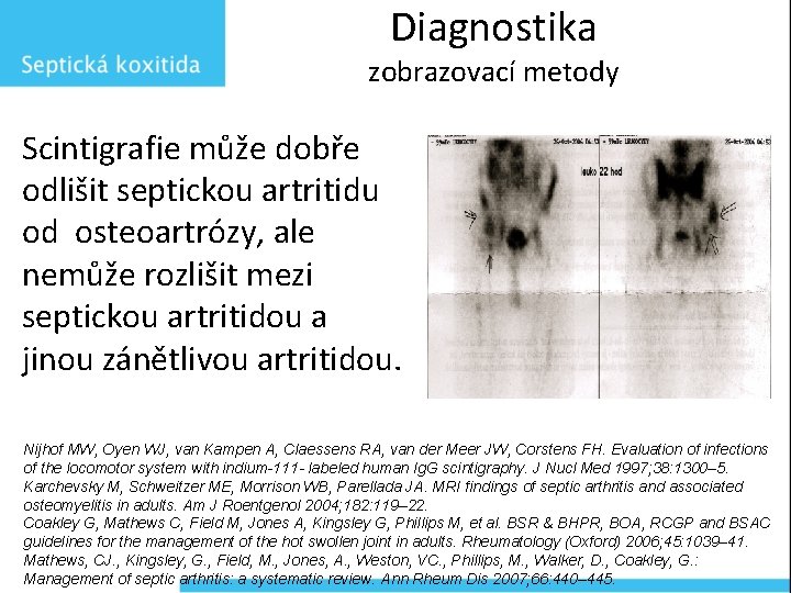 Diagnostika zobrazovací metody Scintigrafie může dobře odlišit septickou artritidu od osteoartrózy, ale nemůže rozlišit