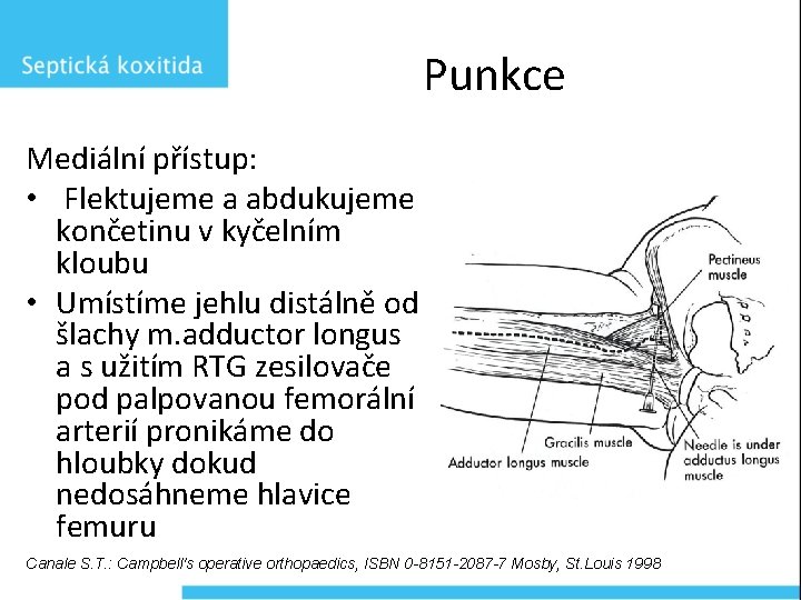 Punkce Mediální přístup: • Flektujeme a abdukujeme končetinu v kyčelním kloubu • Umístíme jehlu