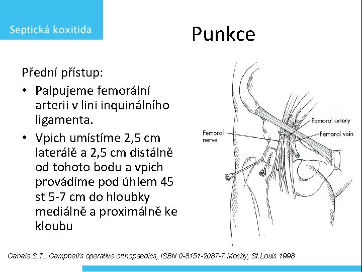 Punkce Přední přístup: • Palpujeme femorální arterii v lini inquinálního ligamenta. • Vpich umístíme
