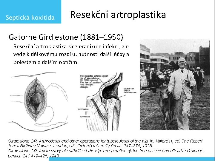 Resekční artroplastika Gatorne Girdlestone (1881– 1950) Resekční artroplastika sice eradikuje infekci, ale vede k