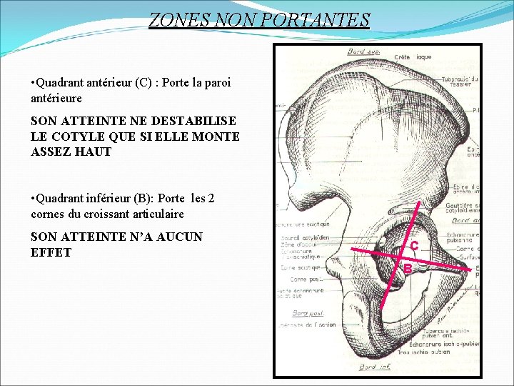 ZONES NON PORTANTES • Quadrant antérieur (C) : Porte la paroi antérieure SON ATTEINTE