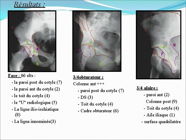 Résultats : Face : 06 elts : - la paroi post du cotyle (7)