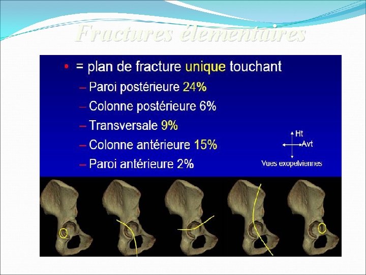 Fractures élementaires 