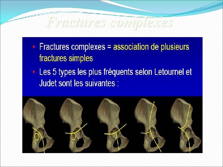 Fractures complexes 