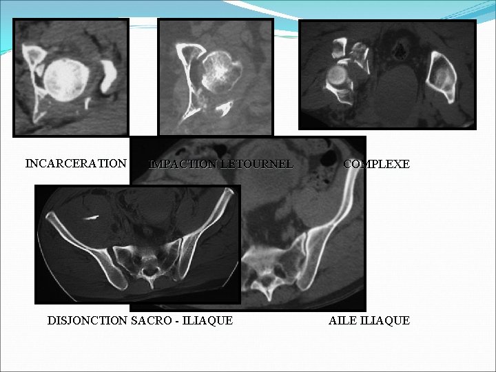 INCARCERATION IMPACTION LETOURNEL DISJONCTION SACRO - ILIAQUE COMPLEXE AILE ILIAQUE 