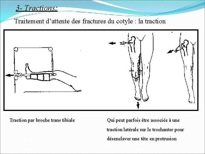 3 - Tractions: Traitement d’attente des fractures du cotyle : la traction Traction par