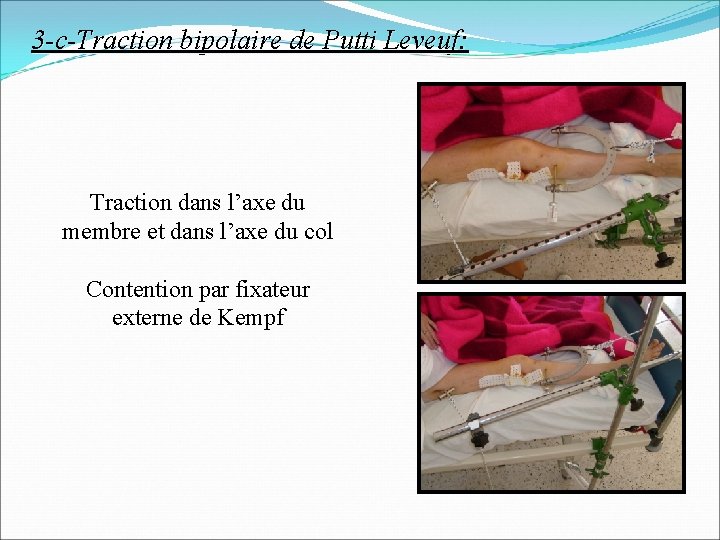 3 -c-Traction bipolaire de Putti Leveuf: Traction dans l’axe du membre et dans l’axe