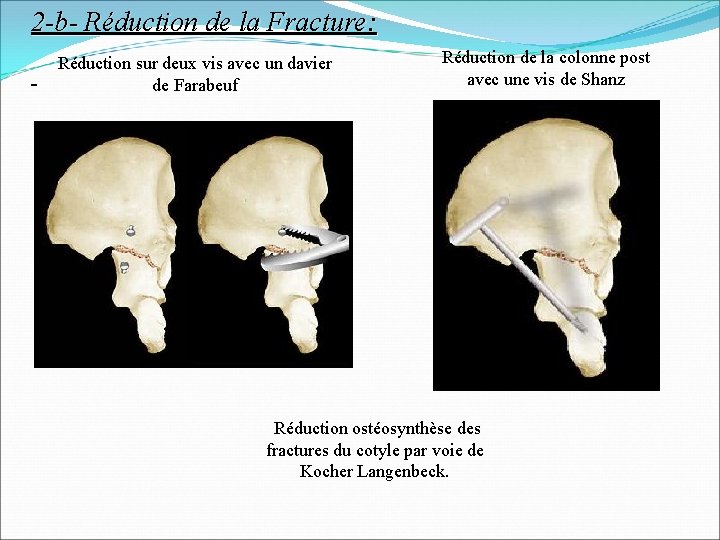 2 -b- Réduction de la Fracture: - Réduction sur deux vis avec un davier