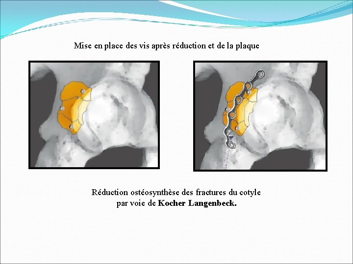 Mise en place des vis après réduction et de la plaque Réduction ostéosynthèse des