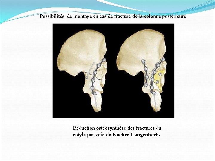 Possibilités de montage en cas de fracture de la colonne postérieure Réduction ostéosynthèse des