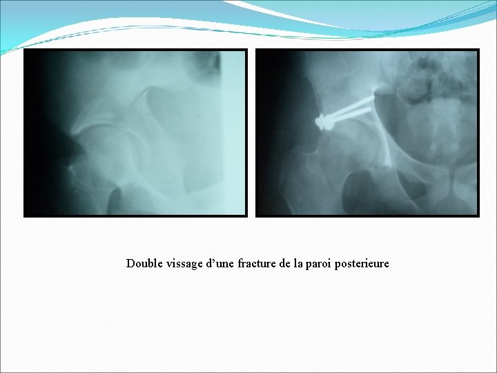 Double vissage d’une fracture de la paroi posterieure 