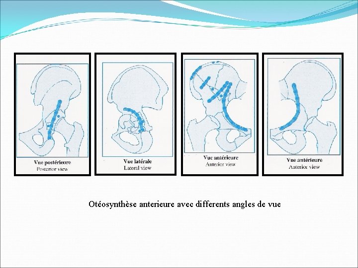 Otéosynthèse anterieure avec differents angles de vue 