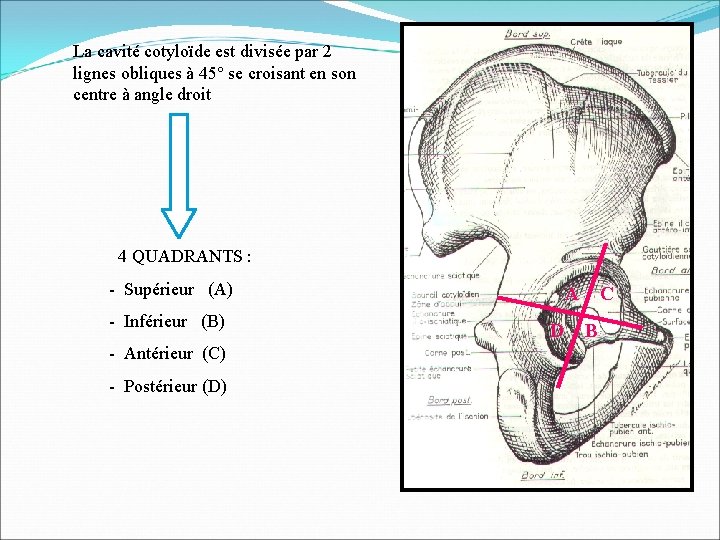 La cavité cotyloïde est divisée par 2 lignes obliques à 45° se croisant en