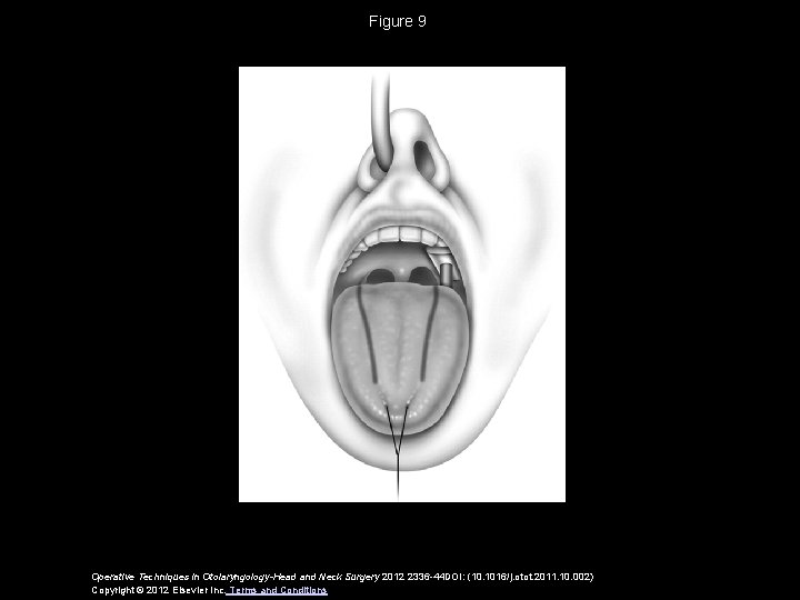 Figure 9 Operative Techniques in Otolaryngology-Head and Neck Surgery 2012 2336 -44 DOI: (10.
