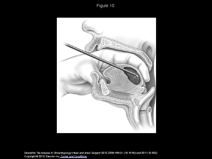 Figure 10 Operative Techniques in Otolaryngology-Head and Neck Surgery 2012 2336 -44 DOI: (10.