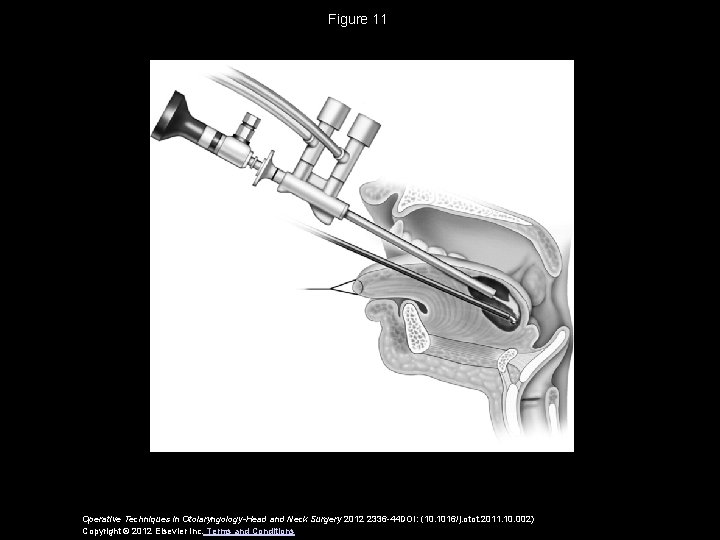 Figure 11 Operative Techniques in Otolaryngology-Head and Neck Surgery 2012 2336 -44 DOI: (10.