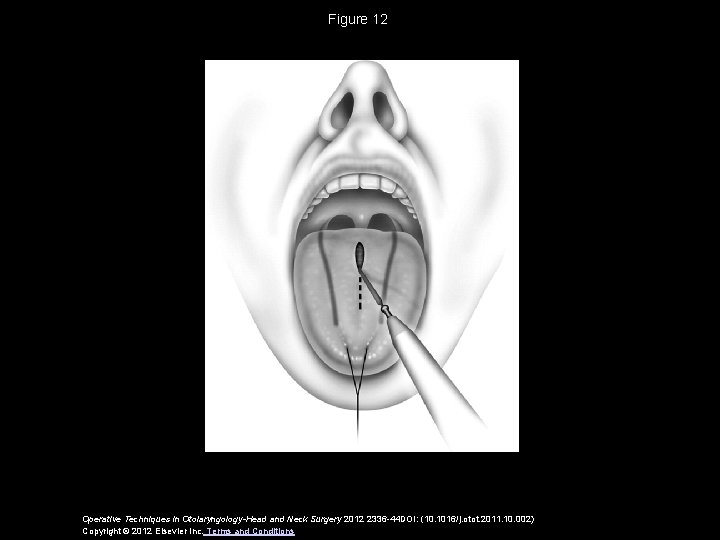 Figure 12 Operative Techniques in Otolaryngology-Head and Neck Surgery 2012 2336 -44 DOI: (10.