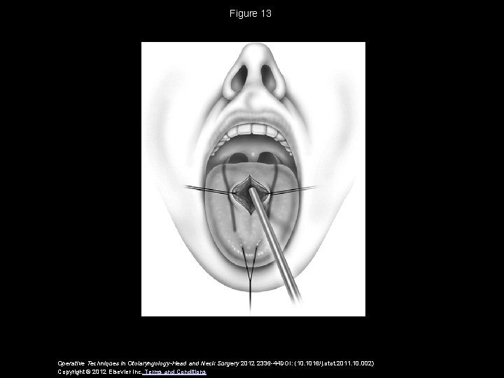 Figure 13 Operative Techniques in Otolaryngology-Head and Neck Surgery 2012 2336 -44 DOI: (10.