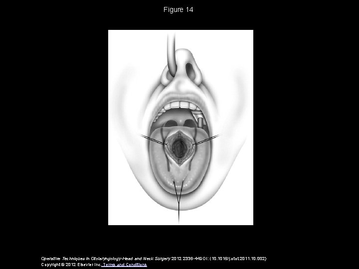 Figure 14 Operative Techniques in Otolaryngology-Head and Neck Surgery 2012 2336 -44 DOI: (10.