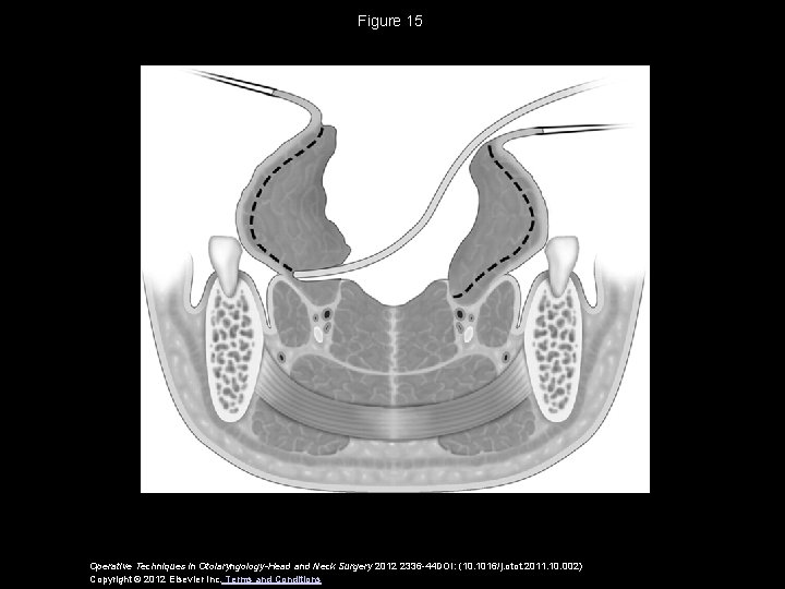 Figure 15 Operative Techniques in Otolaryngology-Head and Neck Surgery 2012 2336 -44 DOI: (10.