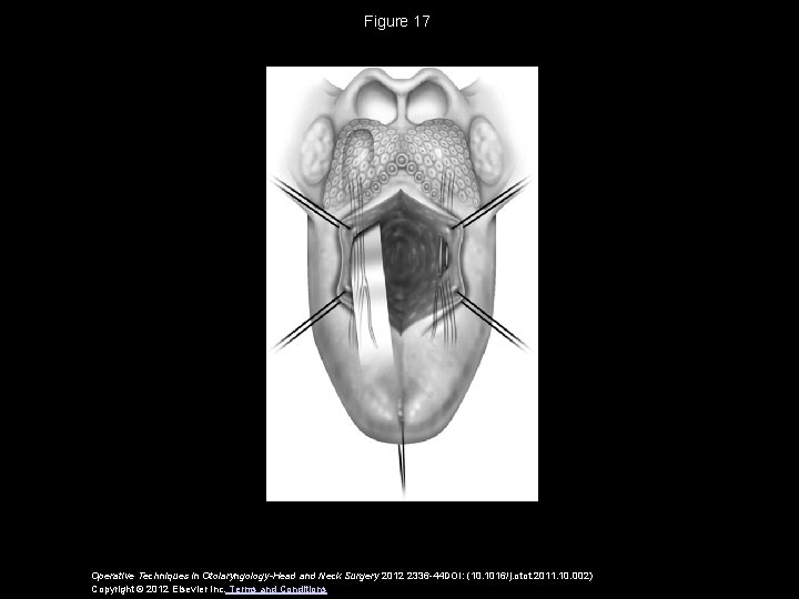 Figure 17 Operative Techniques in Otolaryngology-Head and Neck Surgery 2012 2336 -44 DOI: (10.