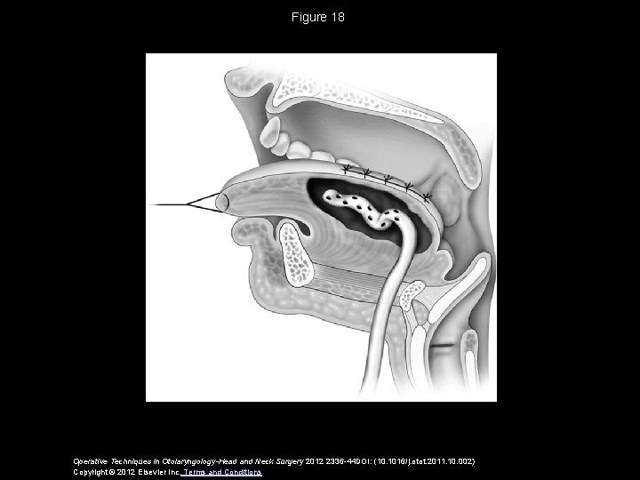 Figure 18 Operative Techniques in Otolaryngology-Head and Neck Surgery 2012 2336 -44 DOI: (10.