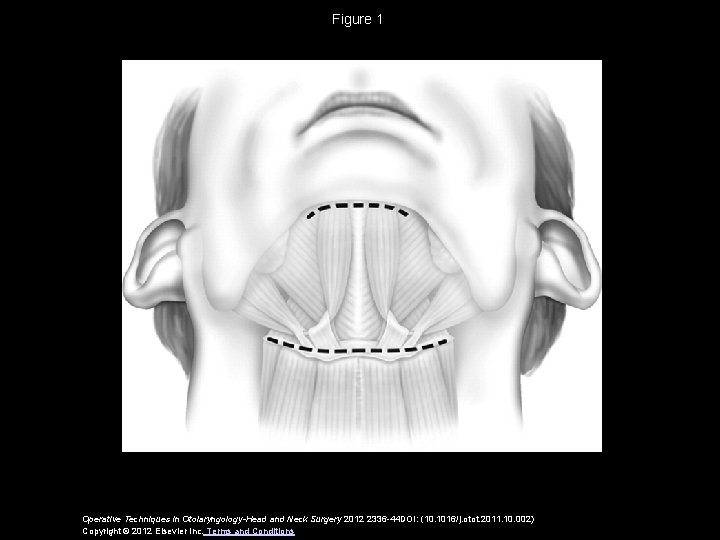 Figure 1 Operative Techniques in Otolaryngology-Head and Neck Surgery 2012 2336 -44 DOI: (10.